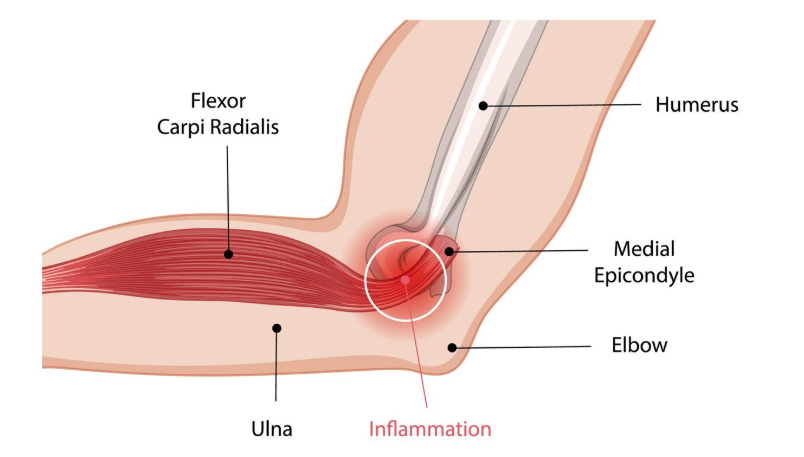 Golfer’s Elbow
