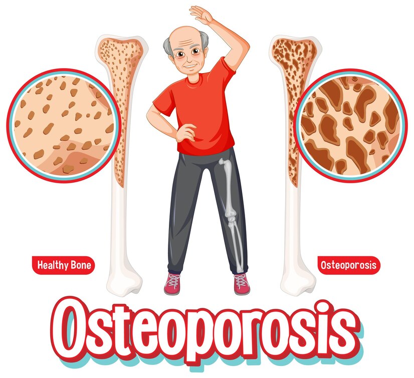 Osteoarthritis