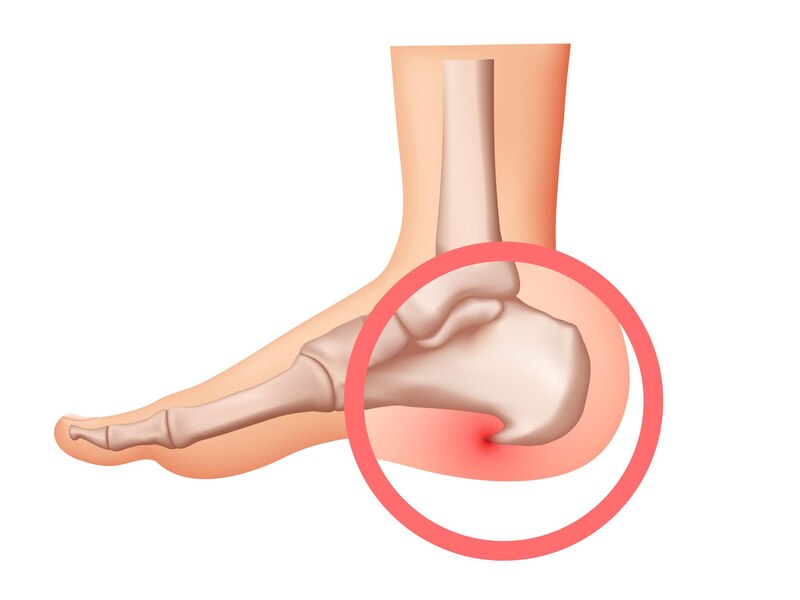 Calcaneal Spur