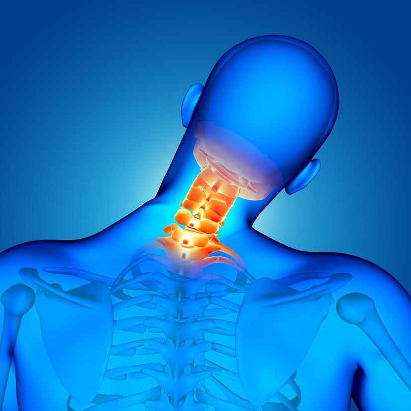 Cervical Spondylosis