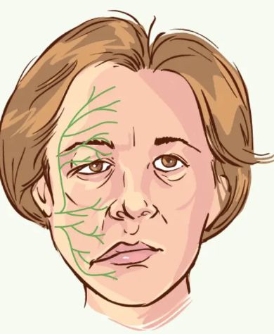 Bell’s Palsy