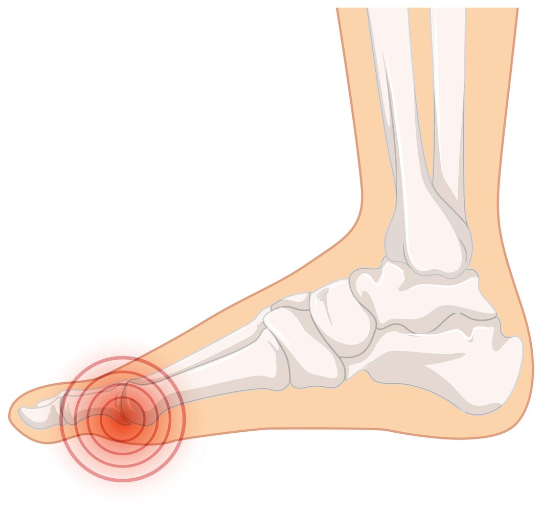 Plantar Fasciitis
