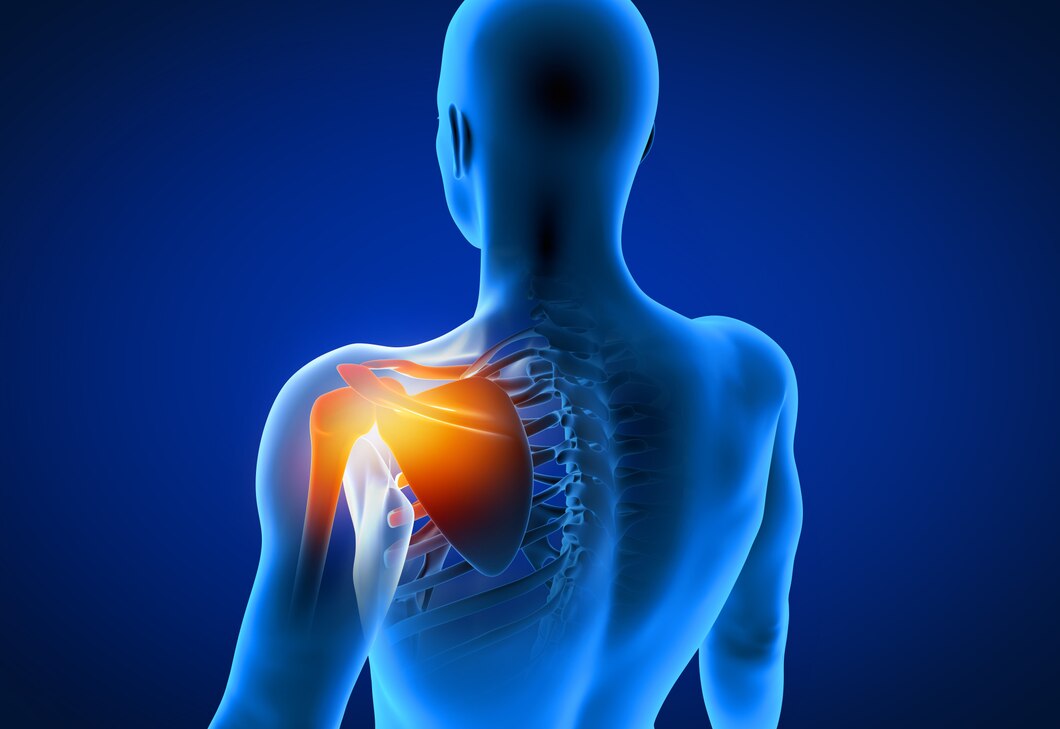 Frozen Shoulder
